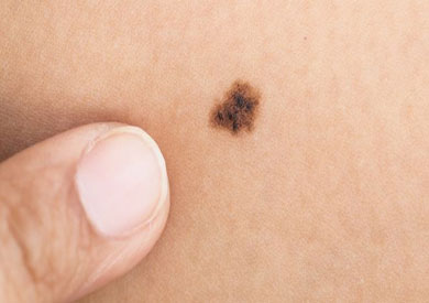 نشرت الدراسة في الدورية البريطانية للأمراض الجلدية، واستخدمت بيانات لثلاثة الآلاف توأم في بريطانيا